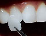 KERAMIČKE I KOMPOZITNE FASETE (viniri, veneers) KERAMIČKE I KOMPOZITNE FASETE