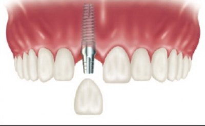 ZUBNI IMPLANTI (dentalni implantati)