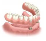 ZUBNI IMPLANTI (dentalni implantati)