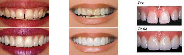KERAMIČKE I KOMPOZITNE FASETE (viniri, veneers) KERAMIČKE I KOMPOZITNE FASETE (viniri, veneers)
